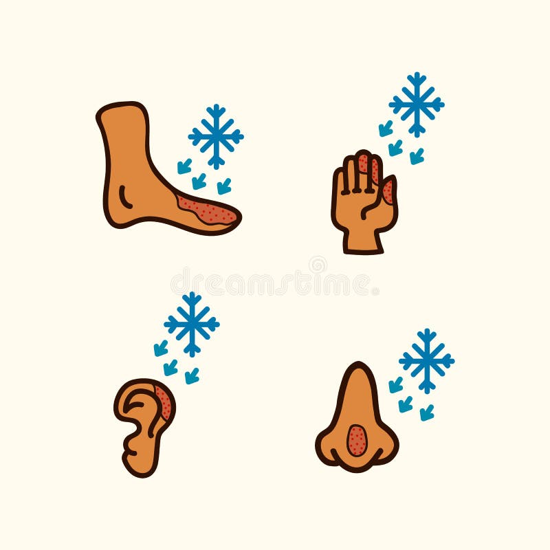 Frostbite of Hands, Foot, Ears and Nose. Hypothermia. Medical