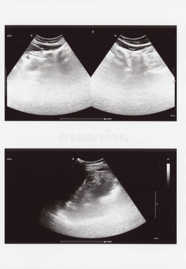 Full Abdomen Ultrasound Sonogram Stock Photo Image of spleen