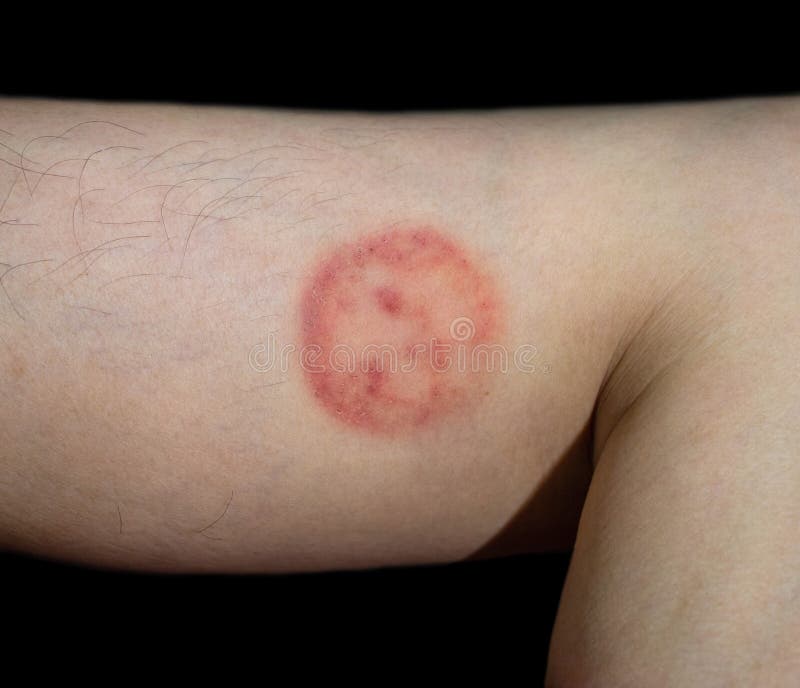 https://thumbs.dreamstime.com/b/fungal-infection-called-tinea-corporis-fungal-infection-called-tinea-corporis-southeast-asian-man-ringworm-260070088.jpg