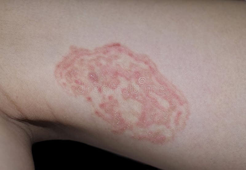 Fungal Infection Called Tinea Corporis In Leg Of Asian Woman Stock Photo -  Download Image Now - iStock