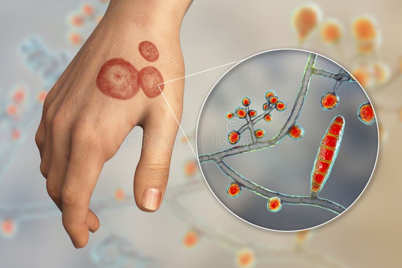 Hand Fungal Infection, Tinea Manuum, 3D Illustration Stock Illustration -  Illustration of septate, microscope: 247910831