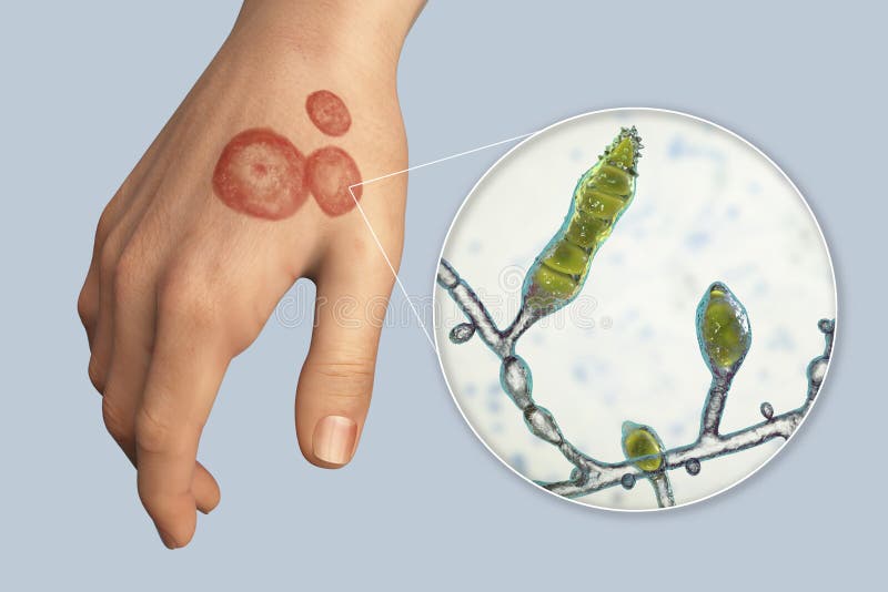 Hand Fungal Infection, Tinea Manuum, 3D Illustration Stock