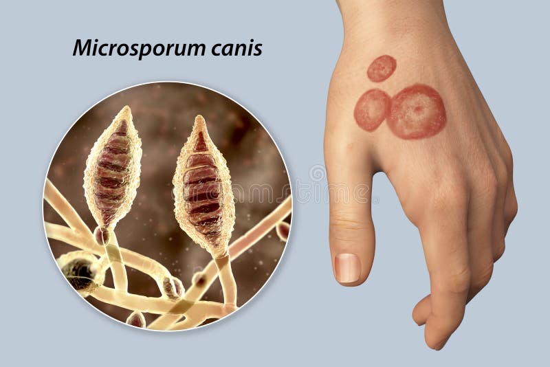 Hand Fungal Infection, Tinea Manuum, 3D Illustration Stock Illustration -  Illustration of male, treatment: 247910772