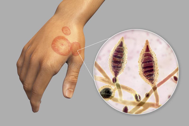 Hand fungal infection, tinea manuum, 3D illustration Stock Illustration