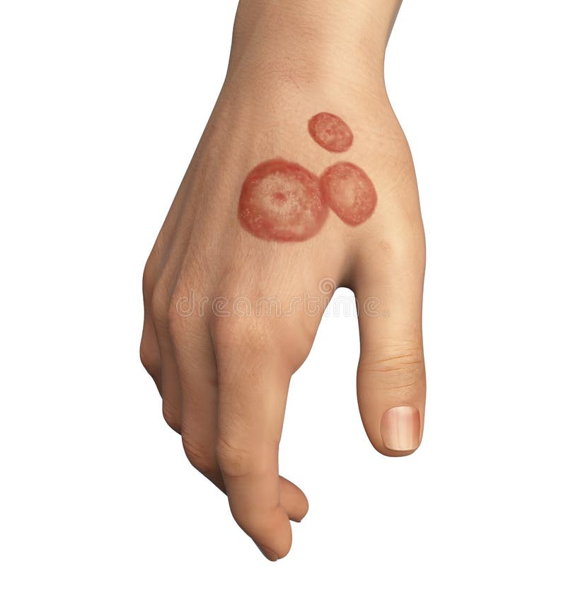 Hand Fungal Infection, Tinea Manuum, 3D Illustration Stock