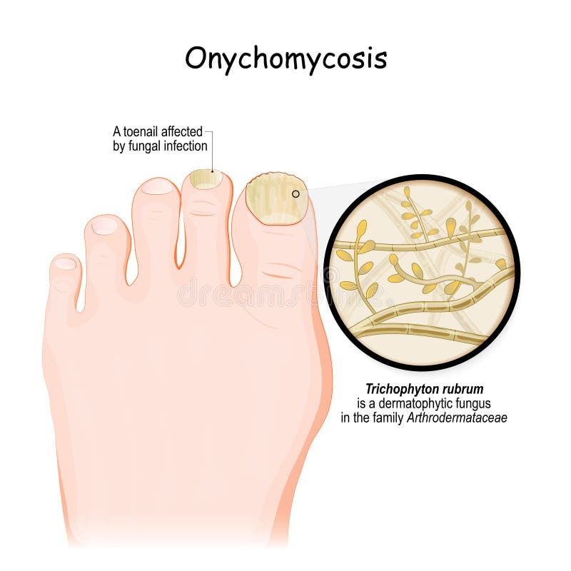 onychomycosis yeast candida /dermatophytes