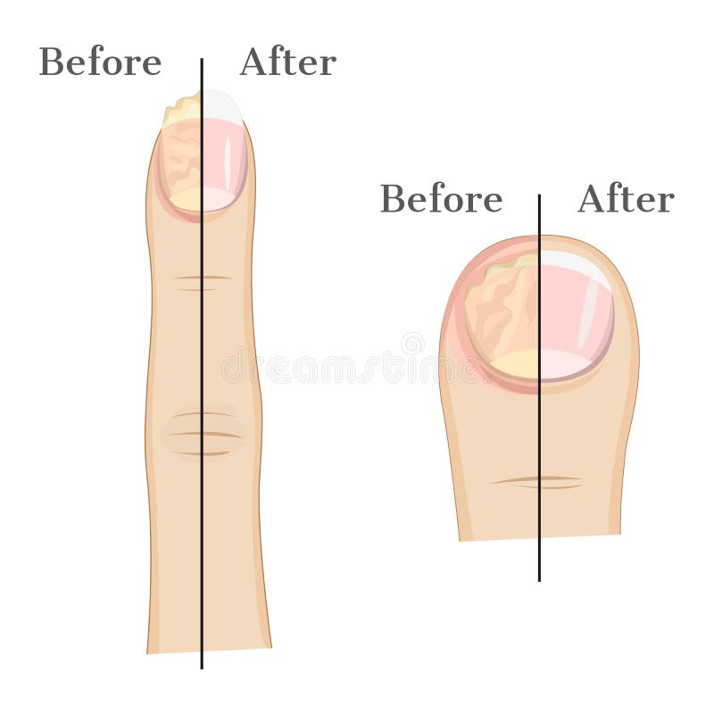 Fungal infection of the nail