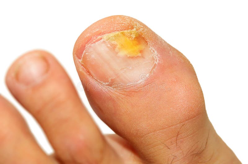 How to Stamp Out Toenail and Foot Fungus