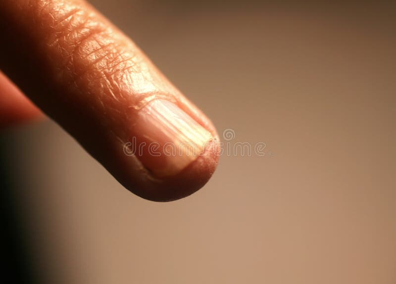 Fungal Infection Under the Nail. a Finger on a Hand with a Fungal