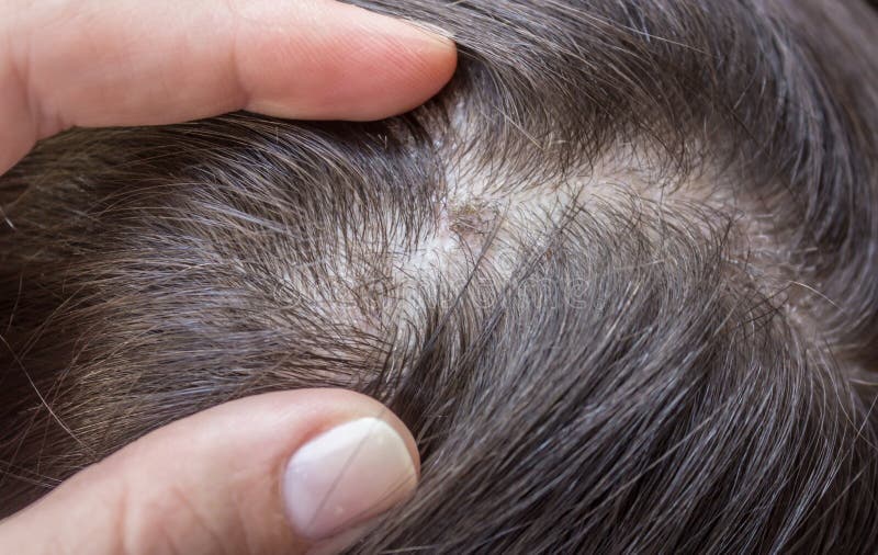 Fungus on the Head of a Little White Girl Stock Photo - Image of ...