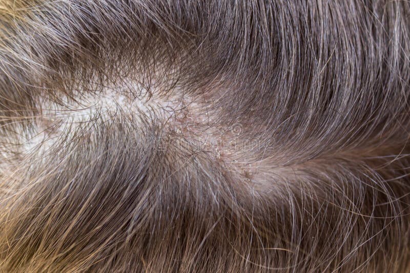 Fungus on the Head of a Little White Girl Stock Image - Image of ...