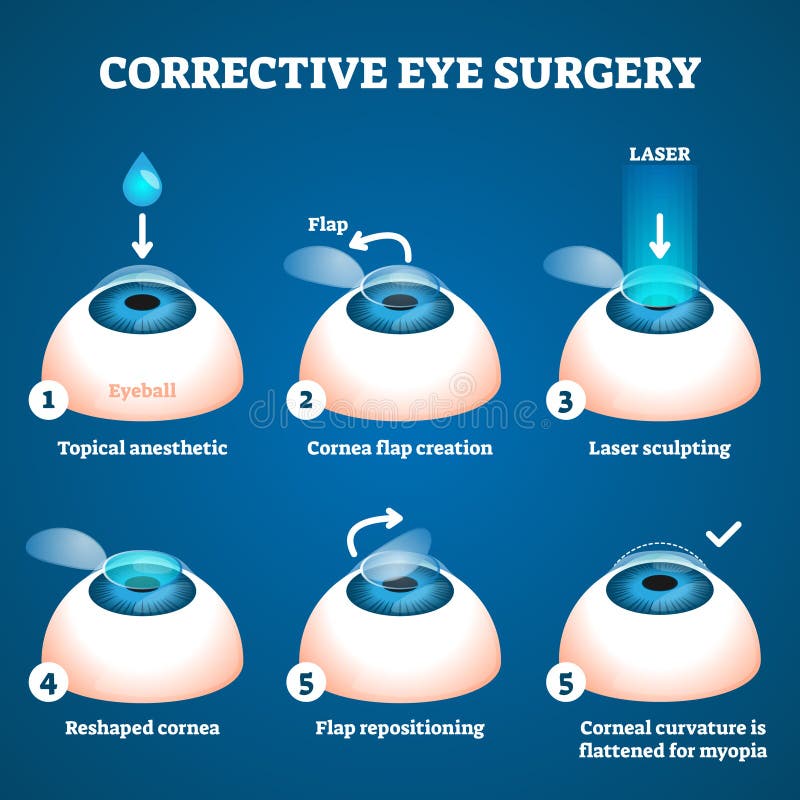Corrective eye surgery vector illustration. Laser process education scheme. Sight improvement with LASIK technology. Procedure process stages visualization with cornea flap creating and sculpting. Corrective eye surgery vector illustration. Laser process education scheme. Sight improvement with LASIK technology. Procedure process stages visualization with cornea flap creating and sculpting.