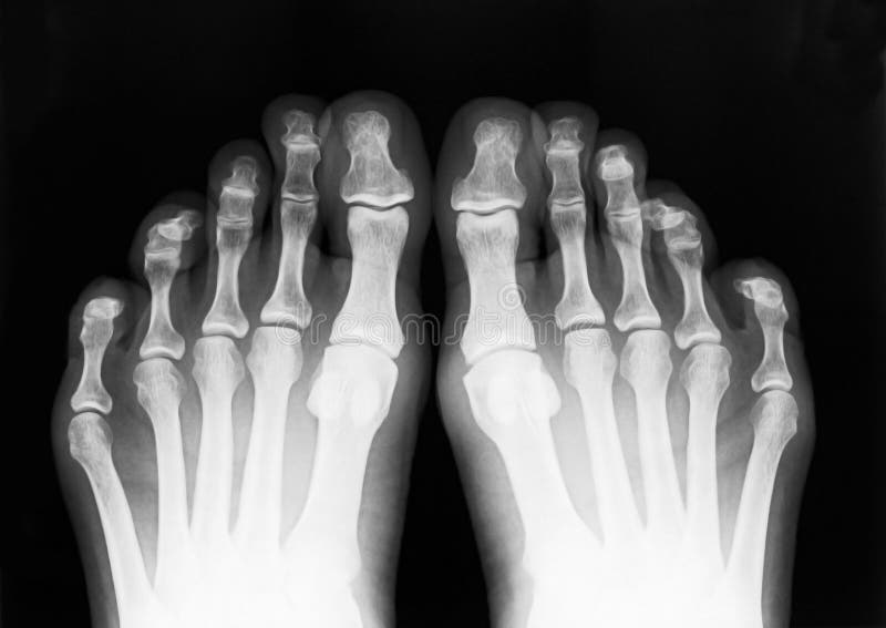 Foot fingers exposed on x-ray black and white film. Foot fingers exposed on x-ray black and white film