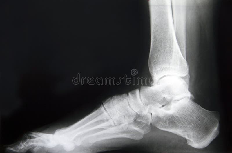 Photo of X-ray human foot. Photo of X-ray human foot