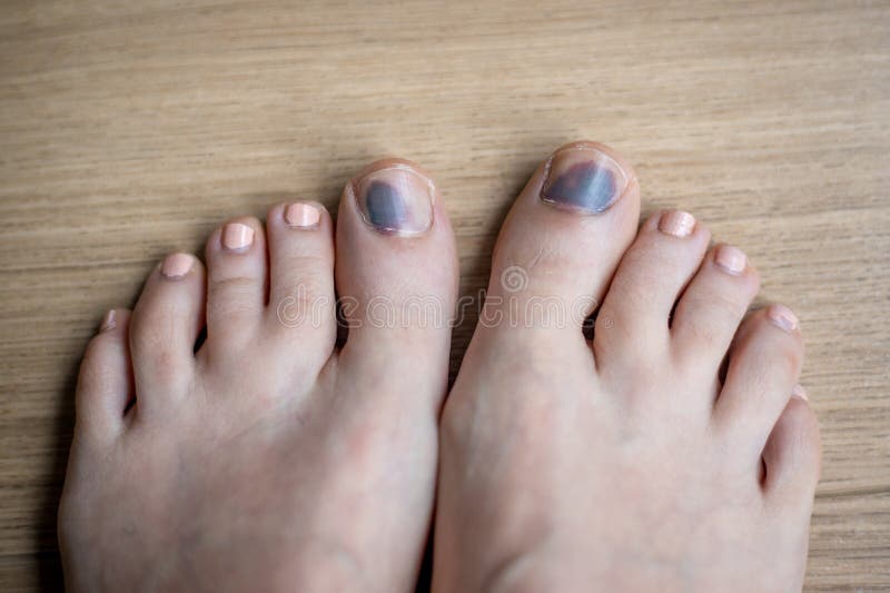 Feet in need of treatments, injuries and nail bruising. Concept, illustrative of need for health care, pedology or dermatology. Close up. Feet in need of treatments, injuries and nail bruising. Concept, illustrative of need for health care, pedology or dermatology. Close up