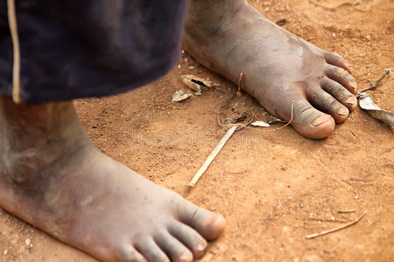 Feet of the Rwanda boy. Feet of the Rwanda boy