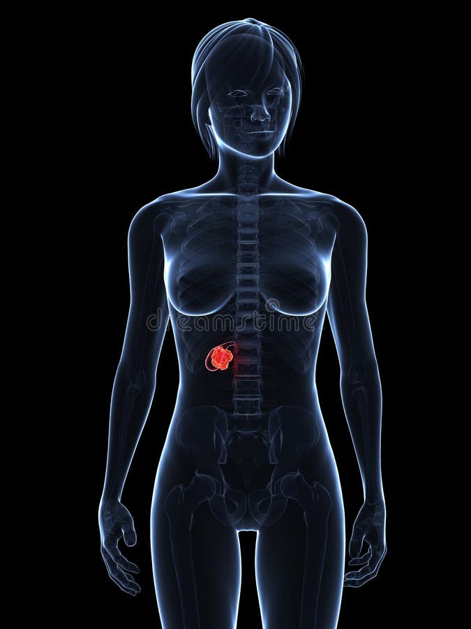 3d stala ilustrácia transparentné ženské telo s nádor v žlčníka.
