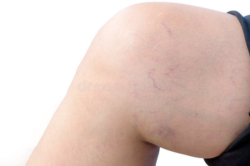 Gamba della donna con le vene varicose fotografia stock Gamba della donna con le vene varicose fotografia stock