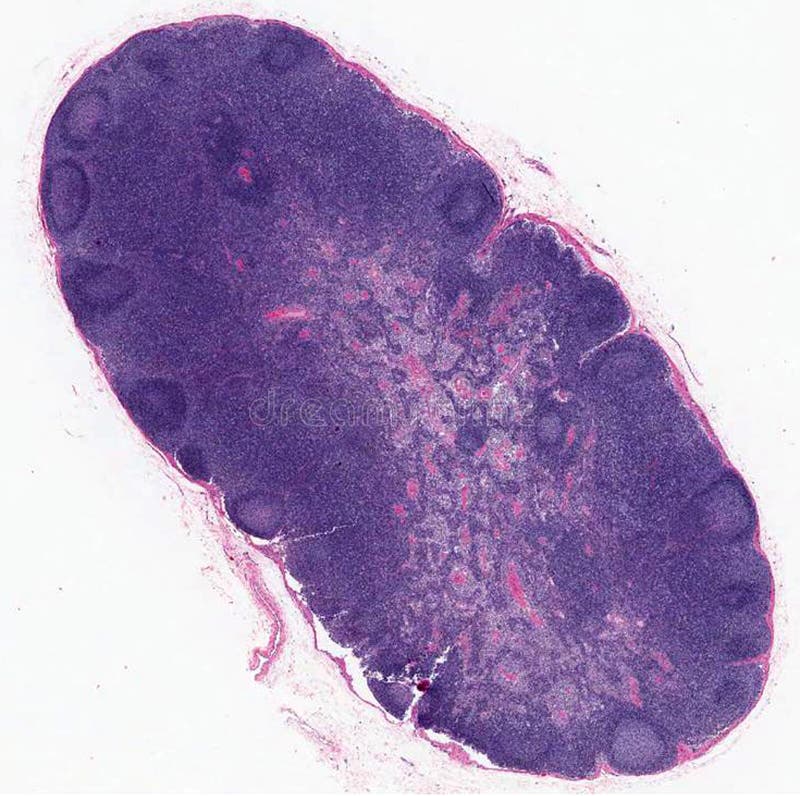 Ganglion lymphatique photo stock Ganglion lymphatique photo stock