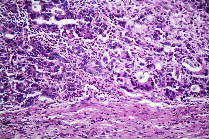 Can Bladder Stones Cause Groin Pain