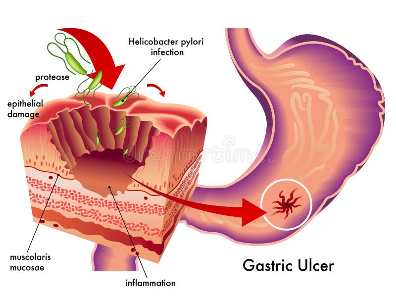 Médico ilustraciones de efectos de gástrico úlcera.