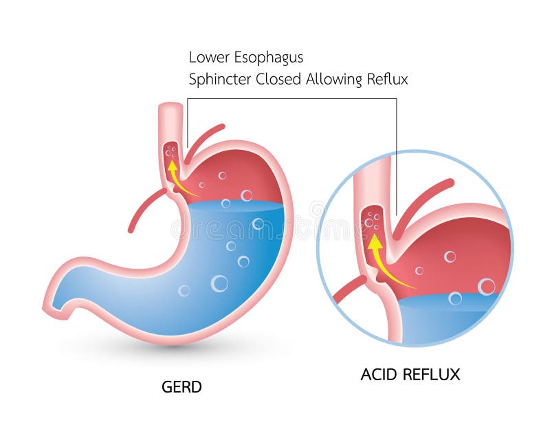 Gastro-oesofageale refluxziekte (GERD) vector illustratie