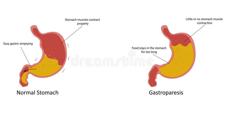 Gastric Motility Stock Illustrations – 69 Gastric Motility Stock
