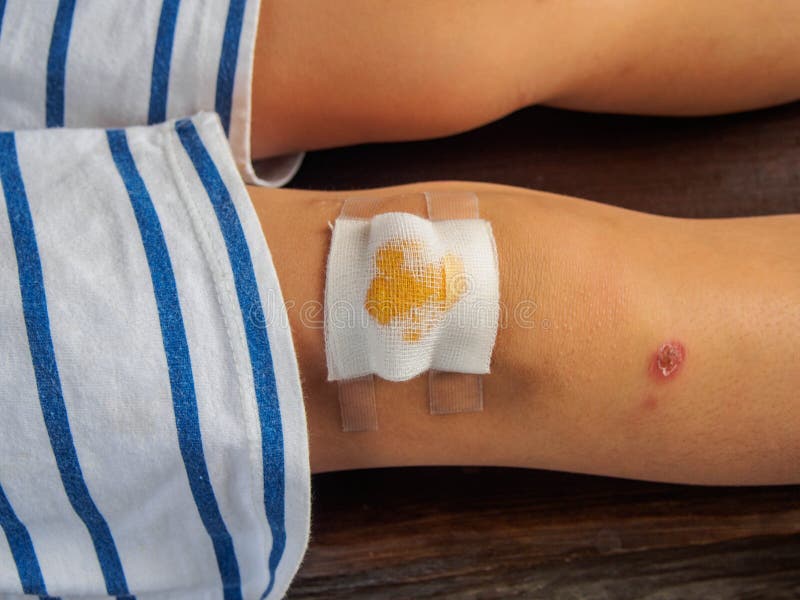 Gauze Cover the Wound on the Boy`s Leg Stock Image Image of
