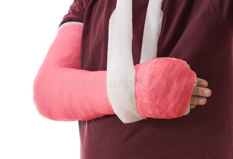 Arm cast - bright red long arm cast in a sling for a broken elbow, arm, or wrist. Arm covered in plaster / gypsum / fiberglass. Isolated on white. Arm cast - bright red long arm cast in a sling for a broken elbow, arm, or wrist. Arm covered in plaster / gypsum / fiberglass. Isolated on white.