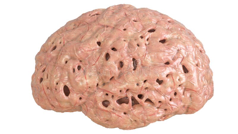 Gehirn in der schweren Erkrankung des Gehirns, Demenz, Alzheimer, Chorea Huntington - Wiedergabe 3D lizenzfreie abbildung Gehirn in der schweren Erkrankung des Gehirns, Demenz, Alzheimer, Chorea Huntington - Wiedergabe 3D lizenzfreie abbildung