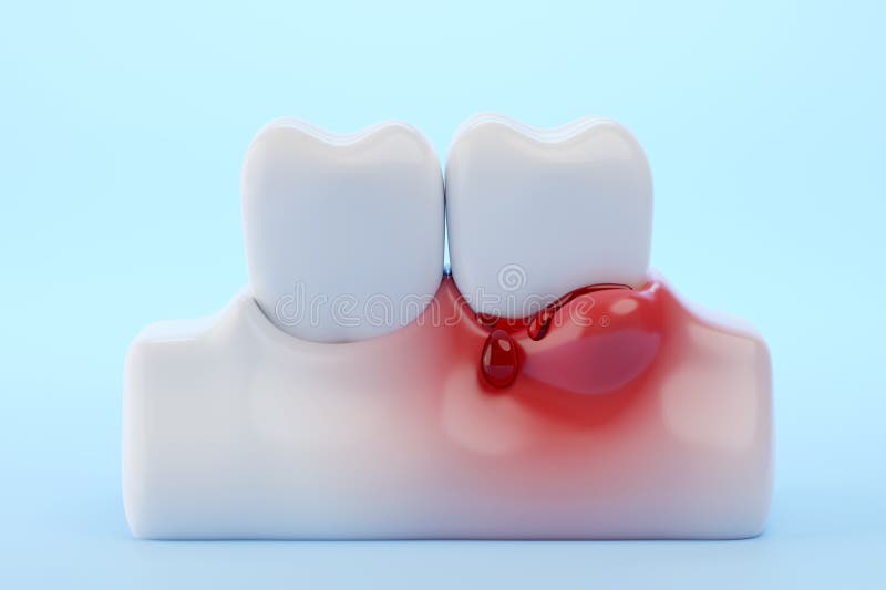 Bleeding gums and teeth blue background for dental disease concept. 3D rendering. Bleeding gums and teeth blue background for dental disease concept. 3D rendering.