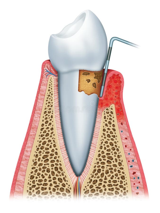 Gingivitis in a state of deterioration of gum and tooth. Gingivitis in a state of deterioration of gum and tooth