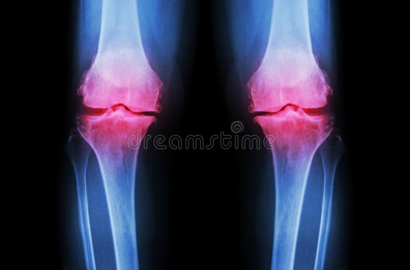 Genou d'ostéoarthrite (genou de bureautique) Rayon X de film les deux l'espace de joint d'étroit d'exposition de genou (vue de fa image stock Genou d'ostéoarthrite (genou de bureautique) Rayon X de film les deux l'espace de joint d'étroit d'exposition de genou (vue de fa image stock