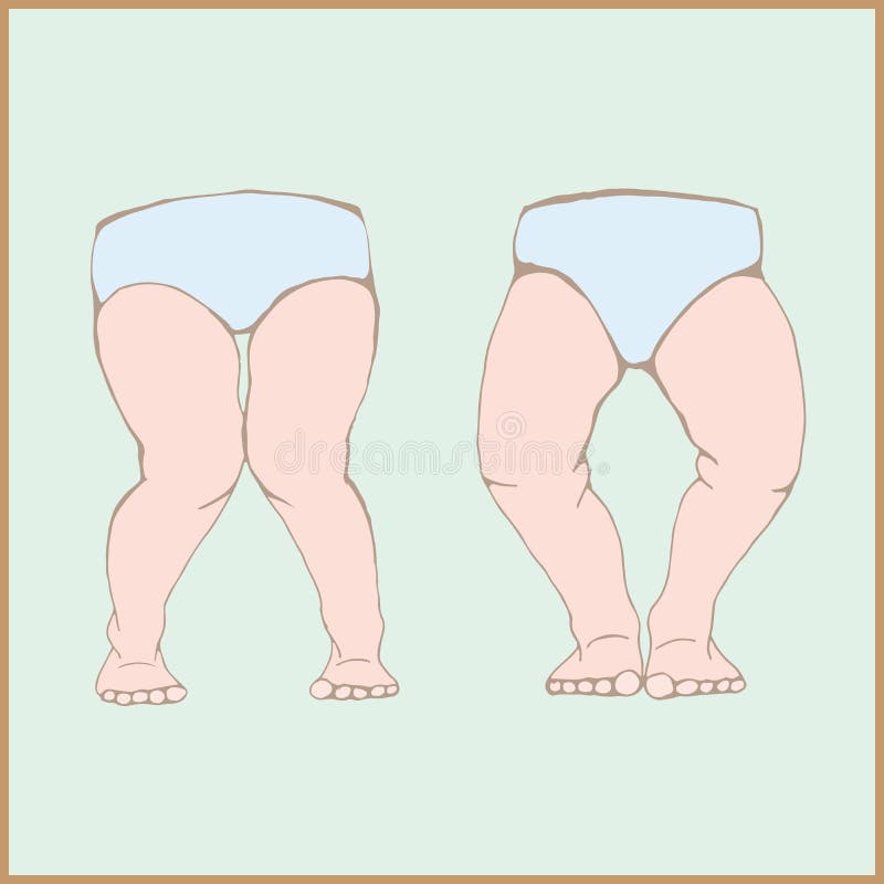 genu varum genu valgum a physical legs deformity stock vector genu valgum