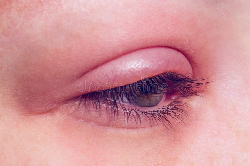 Gersteninfektion auf dem Auge stockfotografie Gersteninfektion auf dem Auge stockfotografie