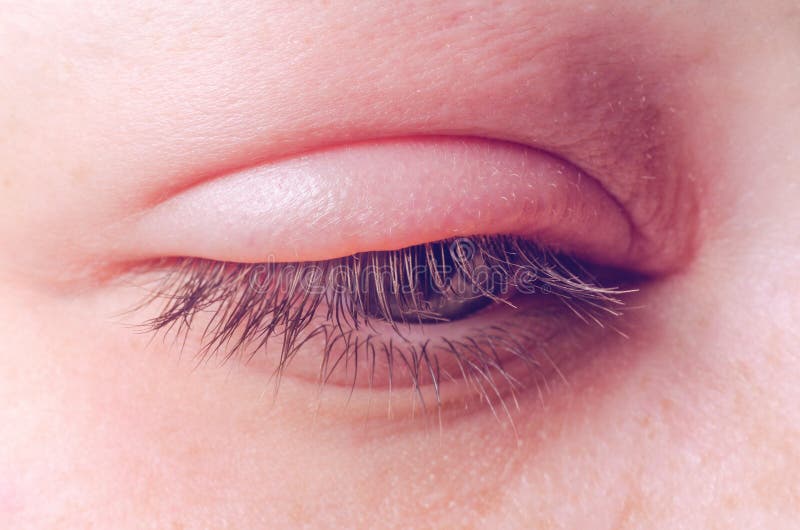  Gersteninfektion auf dem Auge stockbild