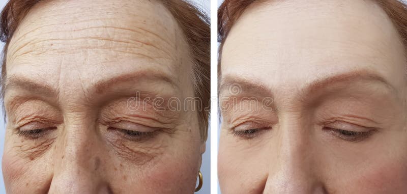 Gesicht einer Chirurgiefrau der älteren Personen knittert Ergebnisdermatologiebehandlungs-Gesichtskollagen, vor und nach Verfahre stockbild Gesicht einer Chirurgiefrau der älteren Personen knittert Ergebnisdermatologiebehandlungs-Gesichtskollagen, vor und nach Verfahre stockbild