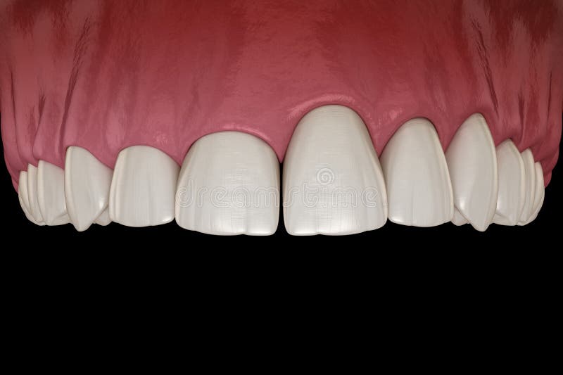 Gingivectomy Surgery with Laser Using. Medically Accurate Tooth 3D