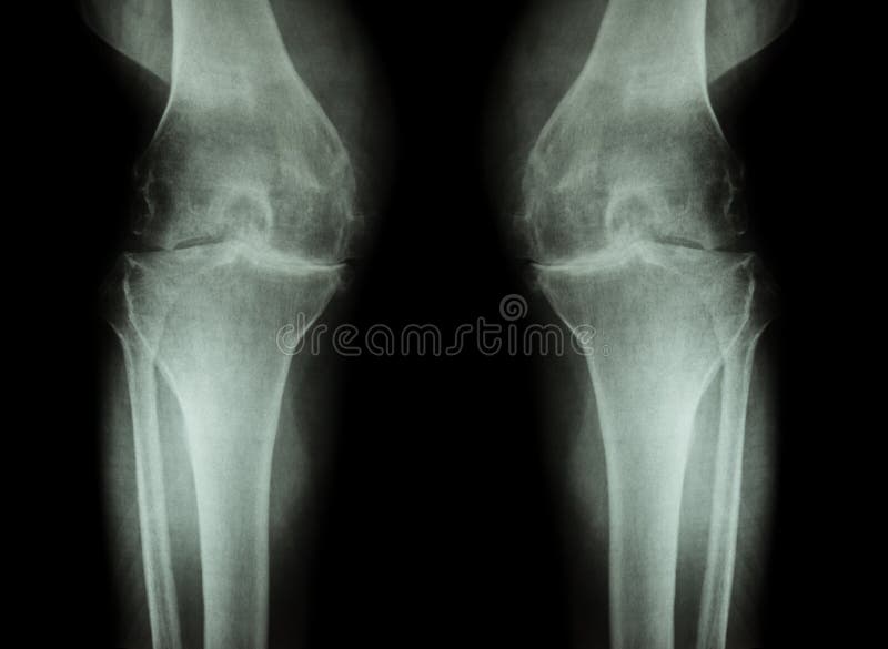 Ginocchio di osteoartrite (ginocchio) di OA (raggi x del film entrambi ginocchio con l'artrite del giunto di ginocchio: spazio st