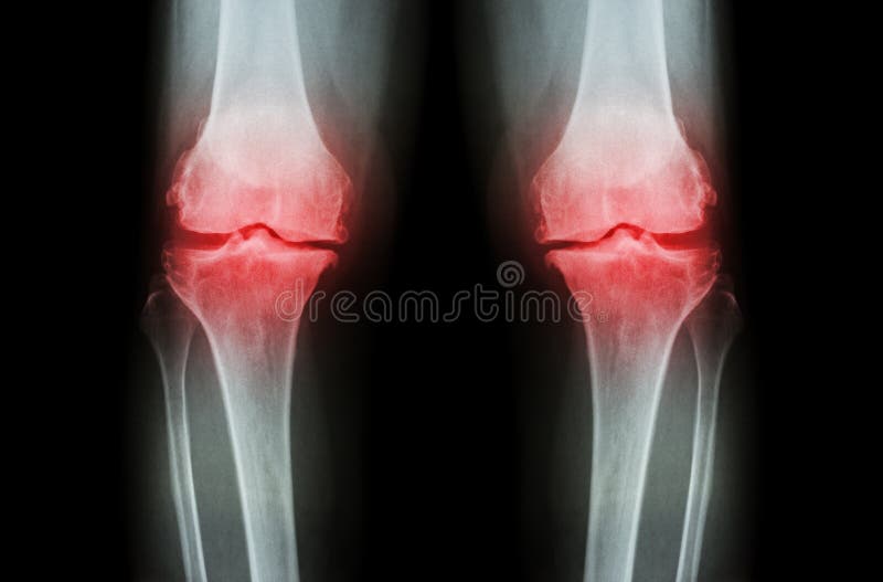 Ginocchio di osteoartrite (ginocchio di OA) Raggi x del film entrambi spazio del giunto dello stretto di manifestazione del ginoc