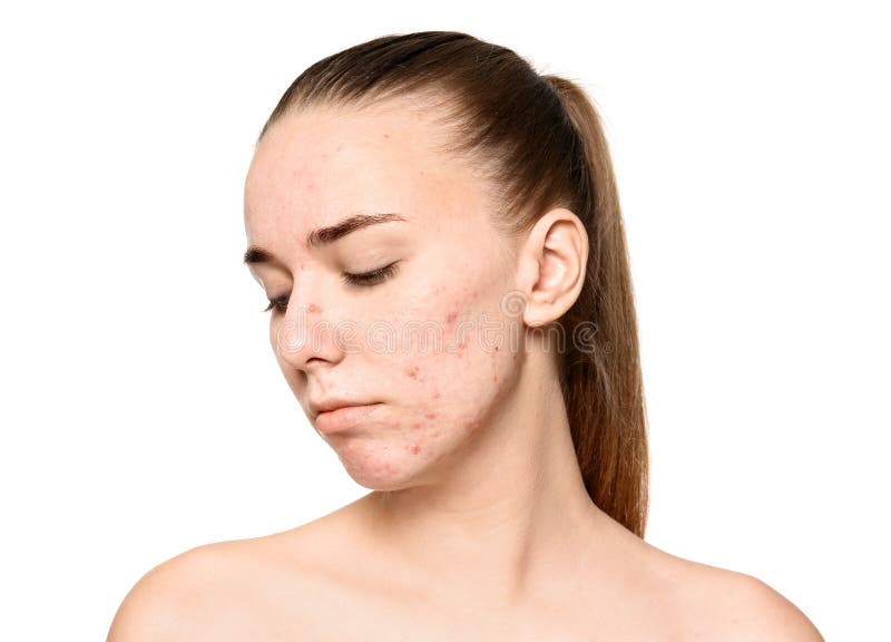 Giovane donna con il problema dell'acne fotografia stock Giovane donna con il problema dell'acne fotografia stock
