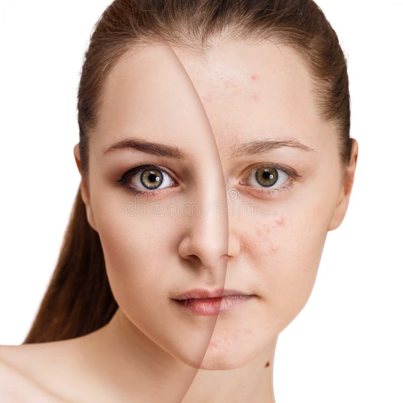 Comparación retrato joven acné antes a después tratamiento a.
