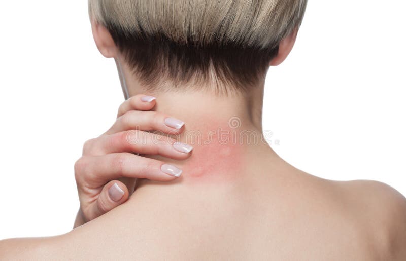 Girl with blond hair, sitting with his back turned and scratching bitten, red, swollen neck skin from mosquito bites in the summer royalty free stock photography Girl with blond hair, sitting with his back turned and scratching bitten, red, swollen neck skin from mosquito bites in the summer royalty free stock photography