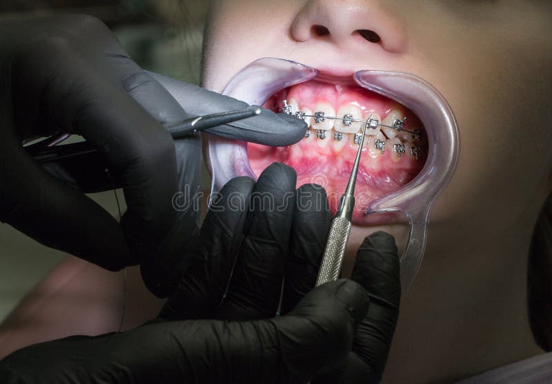 The girl with braces on reception at the dentist-orthodontist. Close-up. Hands in black glove with a tool at the patient`s teeth royalty free stock photography The girl with braces on reception at the dentist-orthodontist. Close-up. Hands in black glove with a tool at the patient`s teeth royalty free stock photography