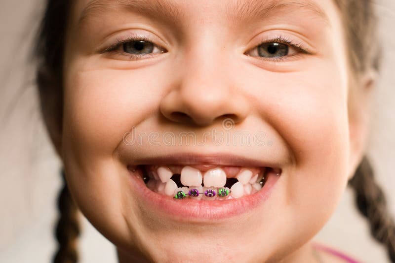 Girl with dental braces