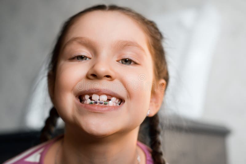 Girl with dental braces