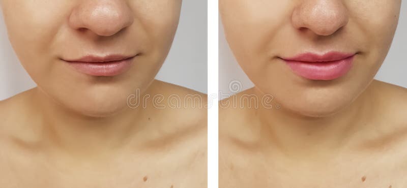 Girl lips increase before and after stock images Girl lips increase before and after stock images