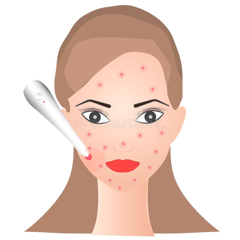 Girl removes acne with a laser royalty free illustration Girl removes acne with a laser royalty free illustration