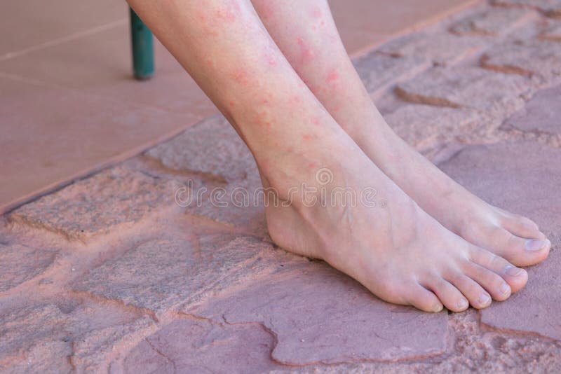 Girland X27s Legs Bitten By Mosquitoes Close Up Woman Scratching Her 