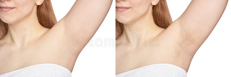 Girl Underarm. White Woman Armpit. before and after Epilation. Stock Image - Image of shave, axillary: 184367043 Girl Underarm. White Woman Armpit. before and after Epilation. Stock Image - Image of shave, axillary: 184367043